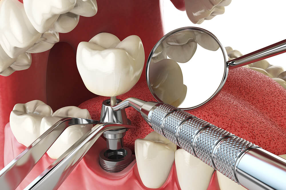 Are Dental Implants Safe LuxeSmile Dentistry