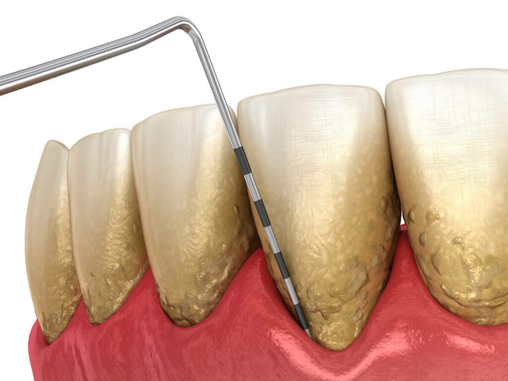 periodontal gum disease treatment graphic
