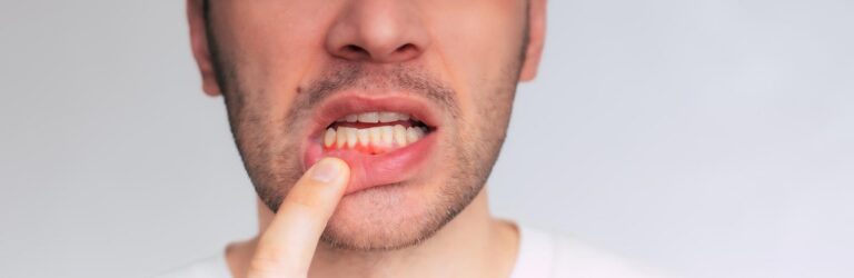 Close up image of gum inflammation. Cropped shot of a young man showing red bleeding gums isolated on a gray background. Dentistry, dental care